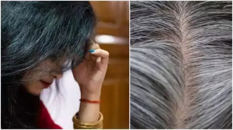 कम उम्र में बाल सफेद होने की वजह: इन विटामिन्स की कमी है मुख्य कारण